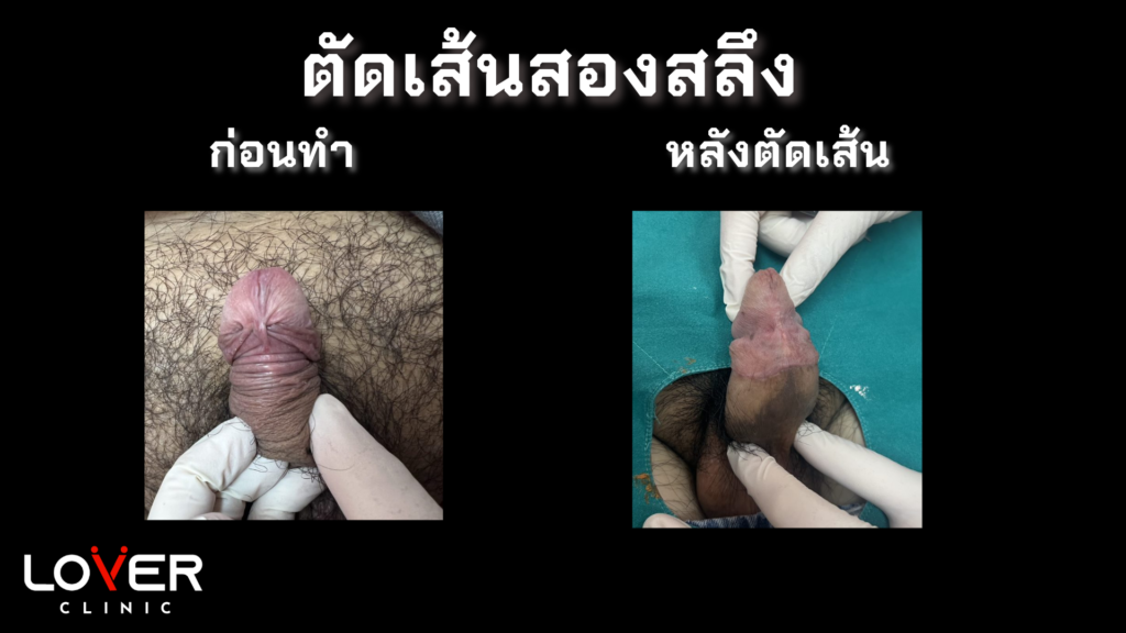 รีวิวขลิบไร้เลือดที่ Lover Clinic โคราช นวัตกรรมใหม่ของการขลิบที่ไม่เจ็บ