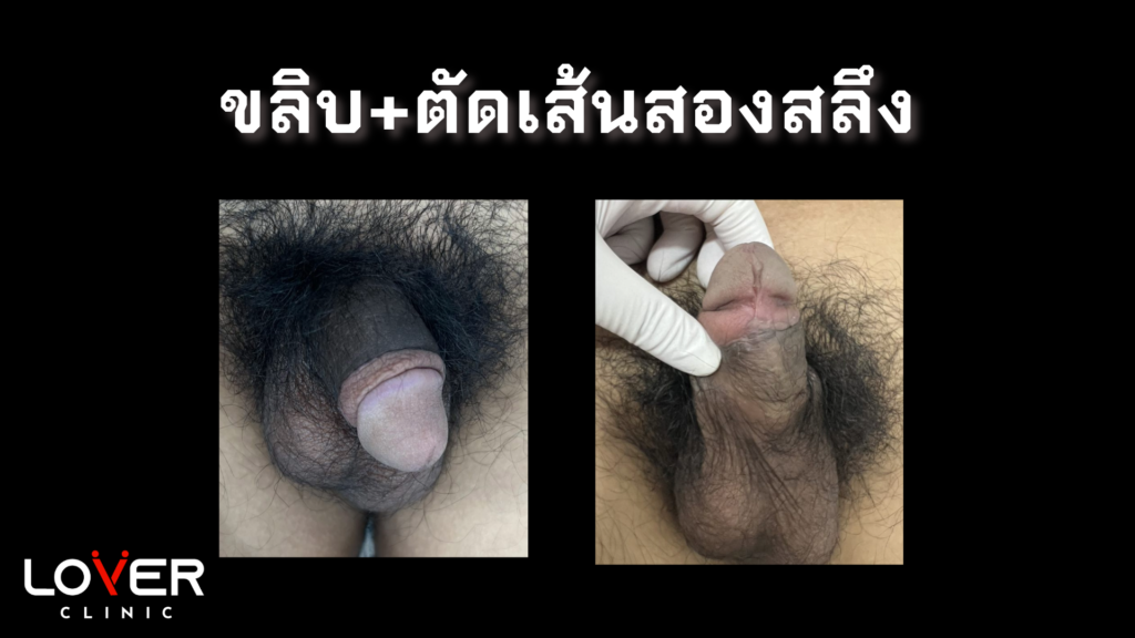 รีวิวขลิบไร้เลือดที่ Lover Clinic โคราช นวัตกรรมใหม่ของการขลิบที่ไม่เจ็บ