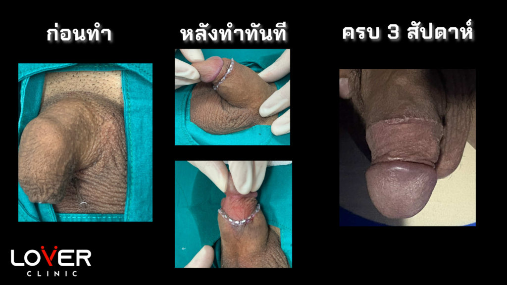 รีวิวขลิบไร้เลือดที่ Lover Clinic โคราช นวัตกรรมใหม่ของการขลิบที่ไม่เจ็บ