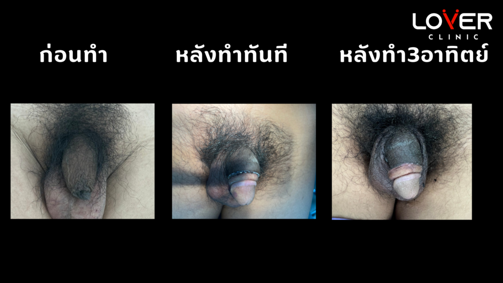 รีวิวขลิบไร้เลือด ที่ Lover Clinic โคราช คลินิกสุขภาพเพศชายครบวงจร