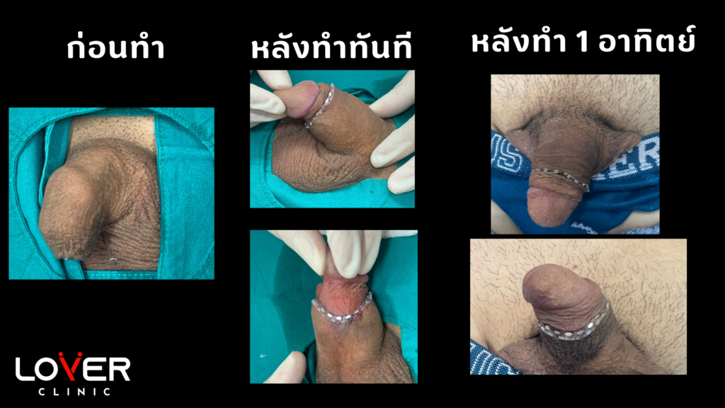 รีวิวขลิบไร้เลือด ที่ Lover Clinic โคราช คลินิกสุขภาพเพศชายครบวงจร