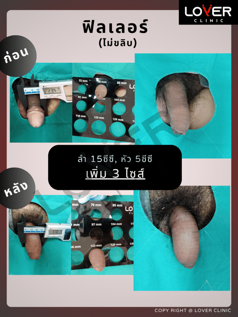 20cc ไม่ขลิบ 900x1200 1