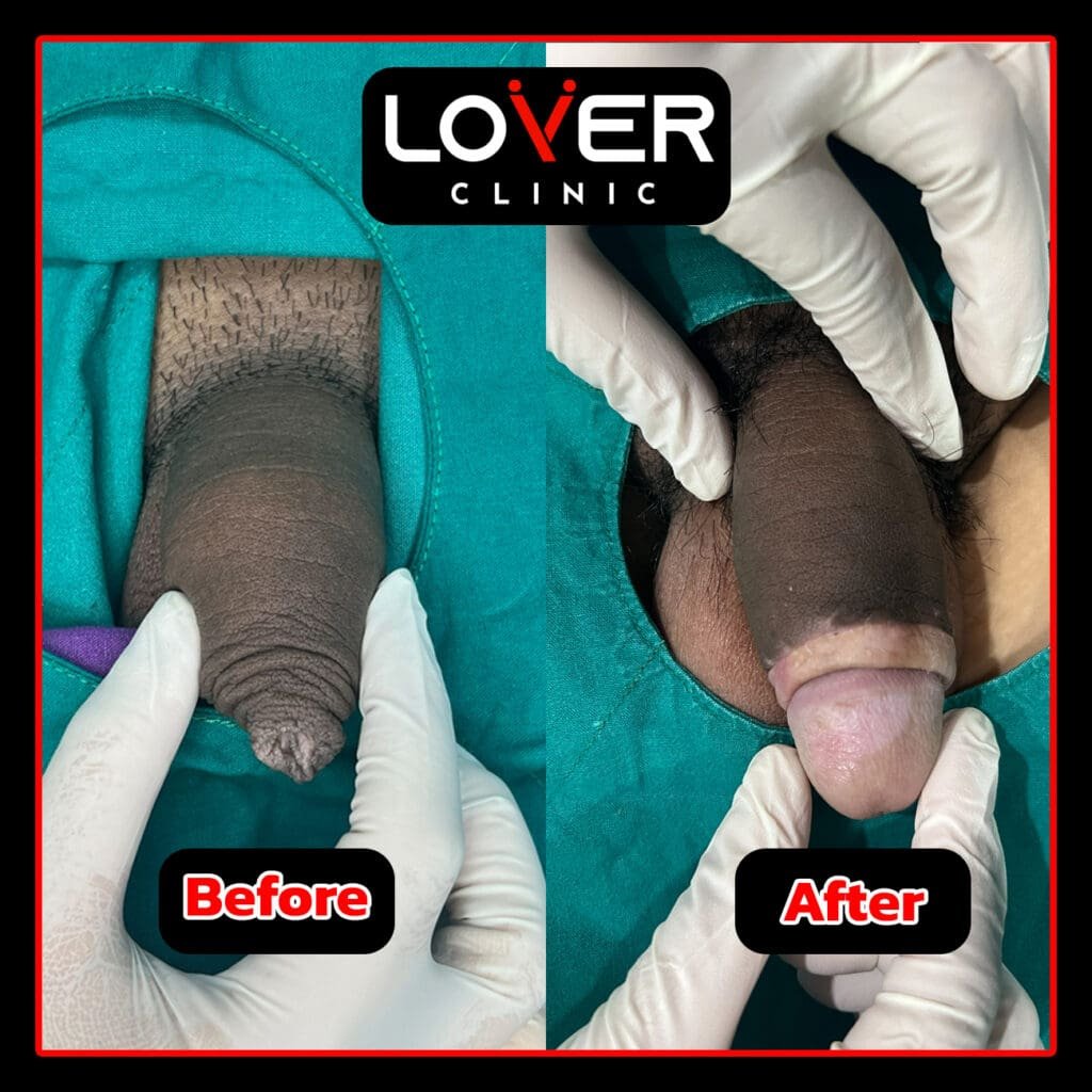 ผลลัพธ์ขลิบเลเซอร์ Sleeve Technique ที่ Lover Clinic รูปที่ 1