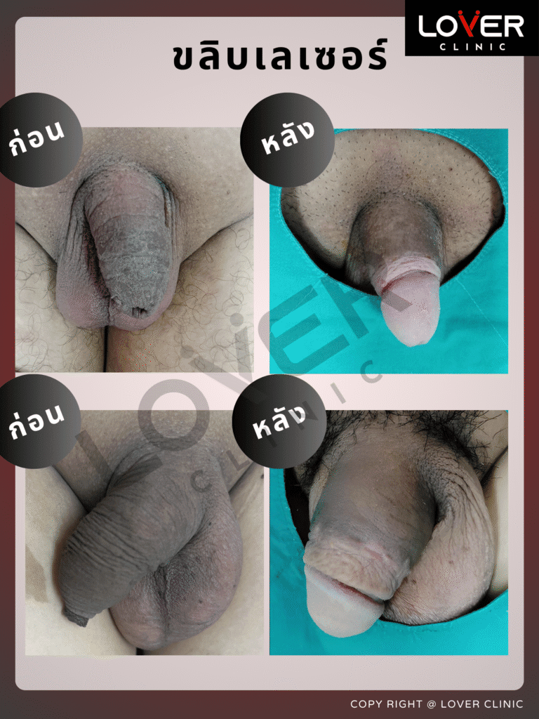 ขลิบเลเซอร์ sleeve2 1