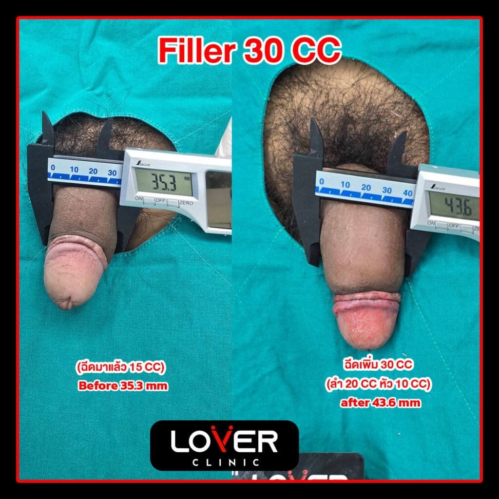 ผลลัพธ์ฟิลเลอร์เพิ่มขนาดพร้อมขลิบ ที่ Lover Clinic รูปที่ 2
