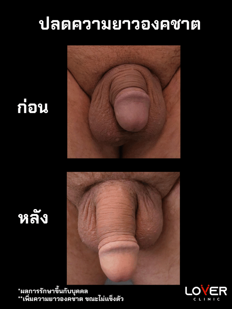 ปลดความยาว 1