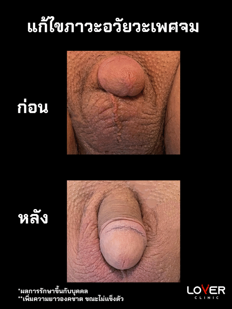 ปลดความยาว 2