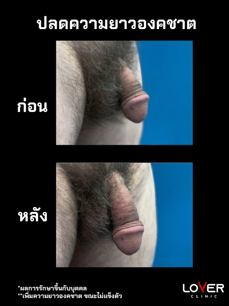ปลดความยาว 3