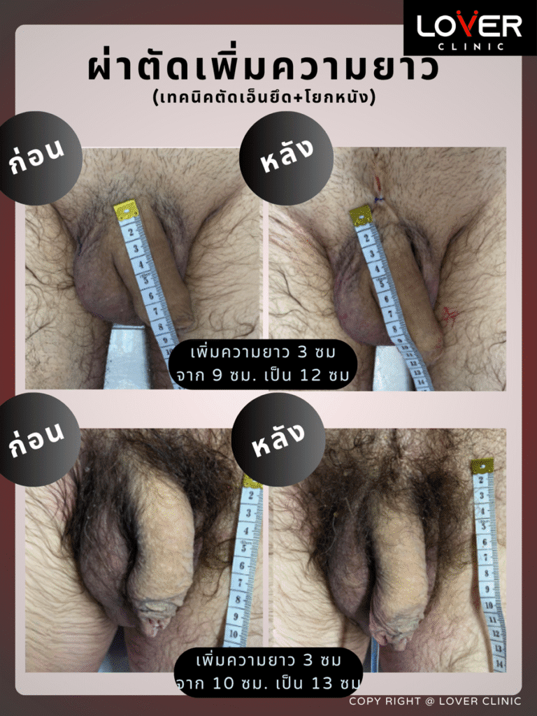 ผ่าตัดเพิ่มความยาว2 900x1200 1