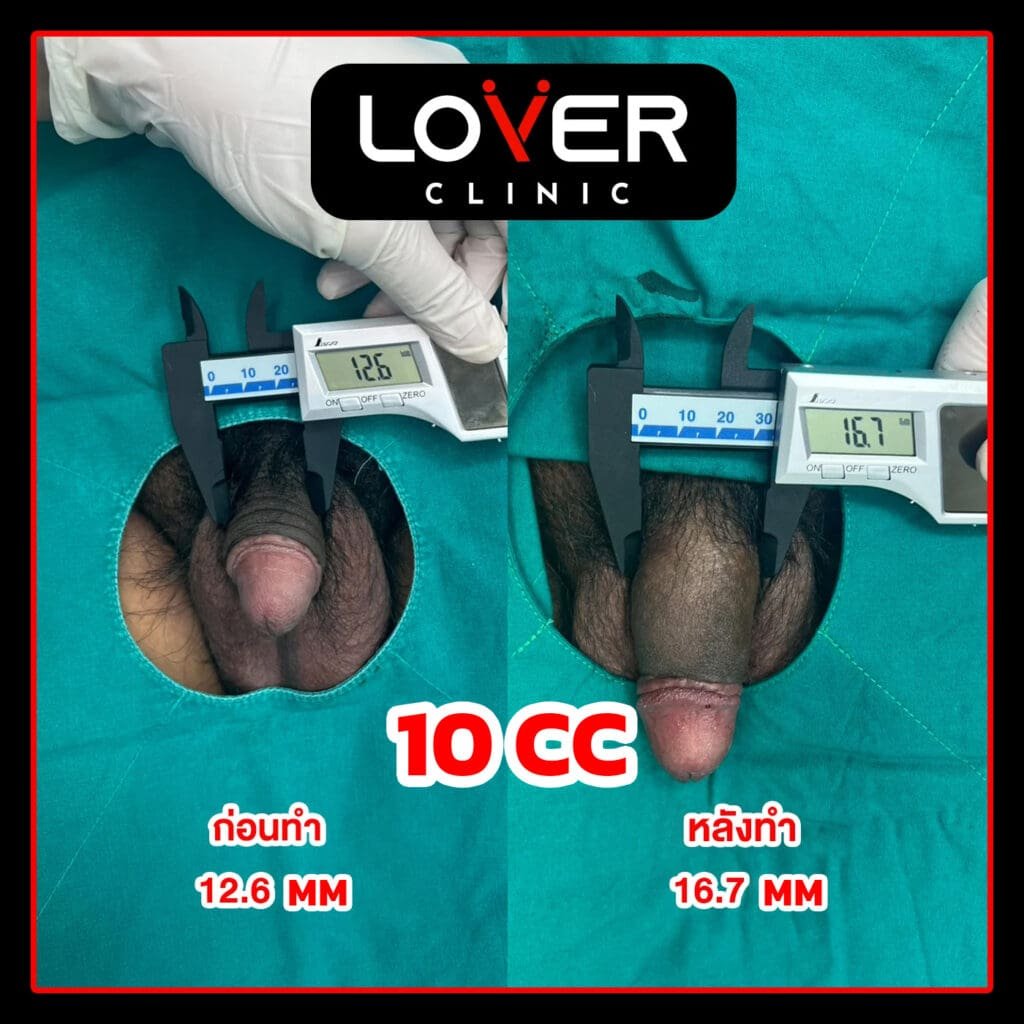 ผลลัพธ์ฟิลเลอร์เพิ่มขนาดพร้อมขลิบ ที่ Lover Clinic รูปที่ 3